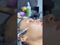 MESO therapy with Peptides and Exosome  , meso injections #mesotherapy #mesoexosome