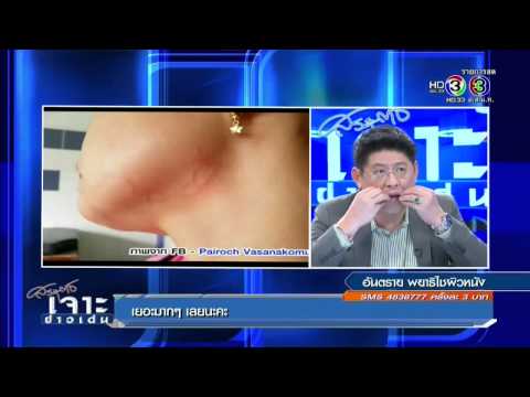 สิ่งที่อาหารที่จำเป็นสำหรับกลาก โรคสะเก็ดเงินและไข่น้ำส้มสายชู