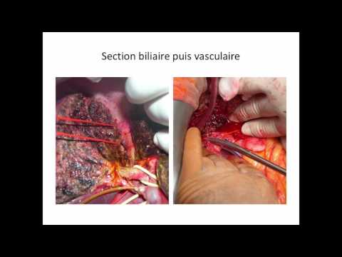 Les complications chez le donneur en transplantation hépatique adulte à donneur vivant