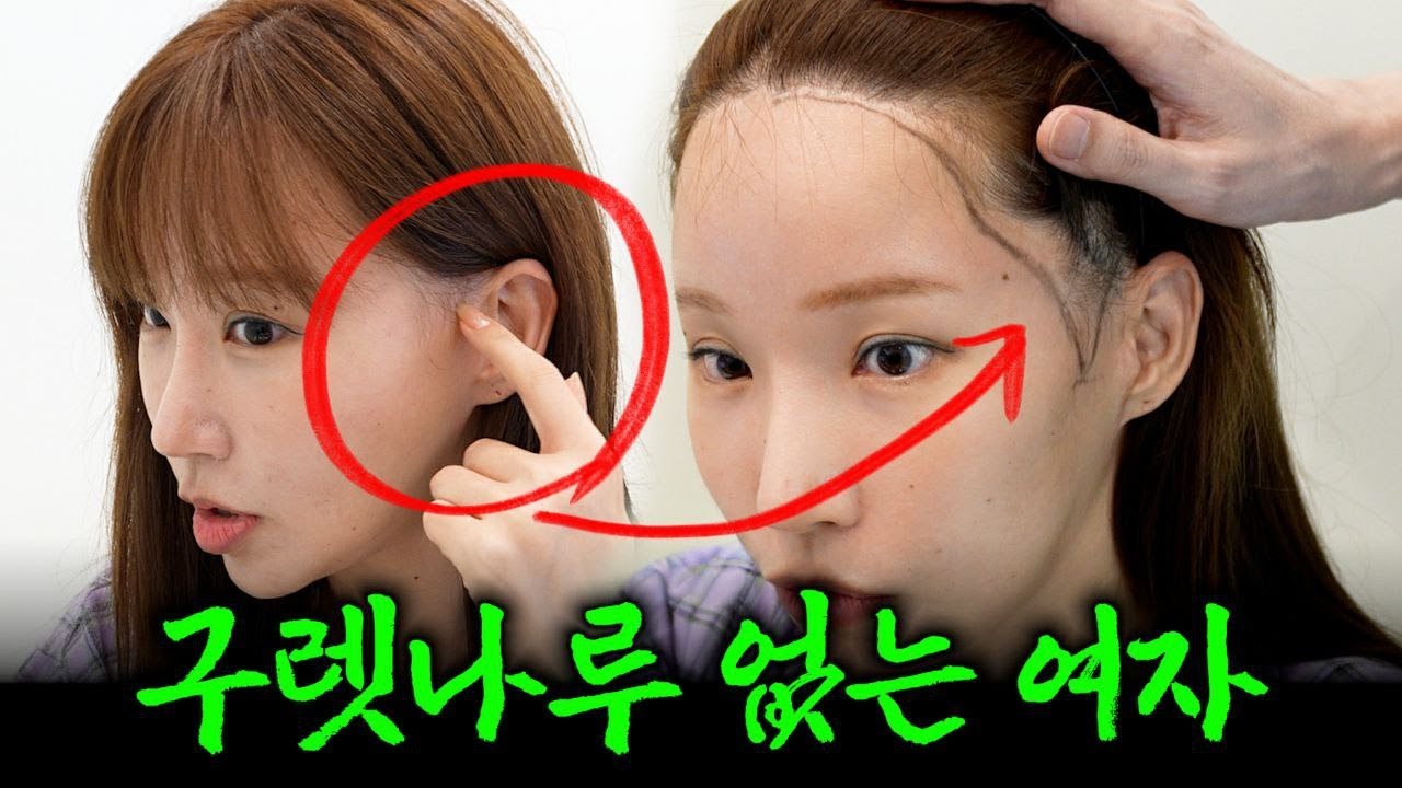 수술로 인해 구렛나루에 머리가 안나요 (+ 두피문신도 망함)