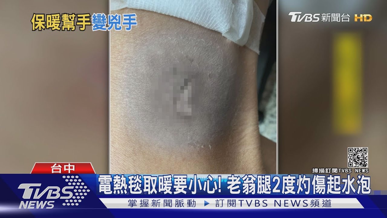 電熱毯取暖要小心！　老翁腿2度灼傷起水泡