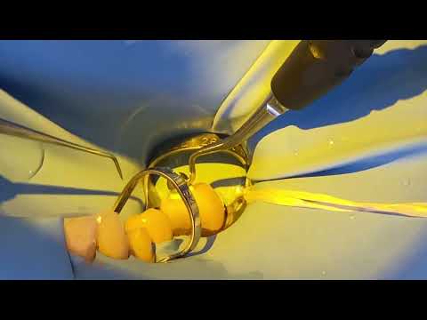 Calset Warmed Composite Cementation Procedure by Dr. Matt Nejad   #addent