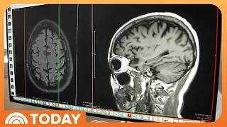 Roche and Eli Lilly’s Alzheimer’s Blood Test Gets FDA Approval