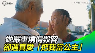 她嚴重燒傷毀容　卻遇見真愛「把我當公主」