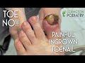 TOE NO Painful Ingrown Toenail Removal