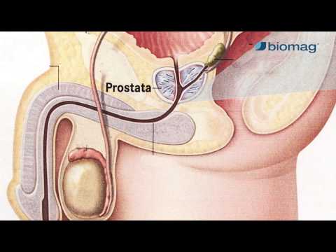 Prostata-Behandlung eines Tennisballs Chronische Prostatitis und Prostata-Massage