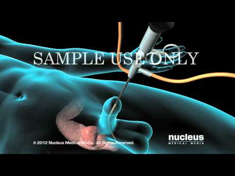 Trattamento di farmaco prostatite Trattamento prostatite con ciprofloxacina