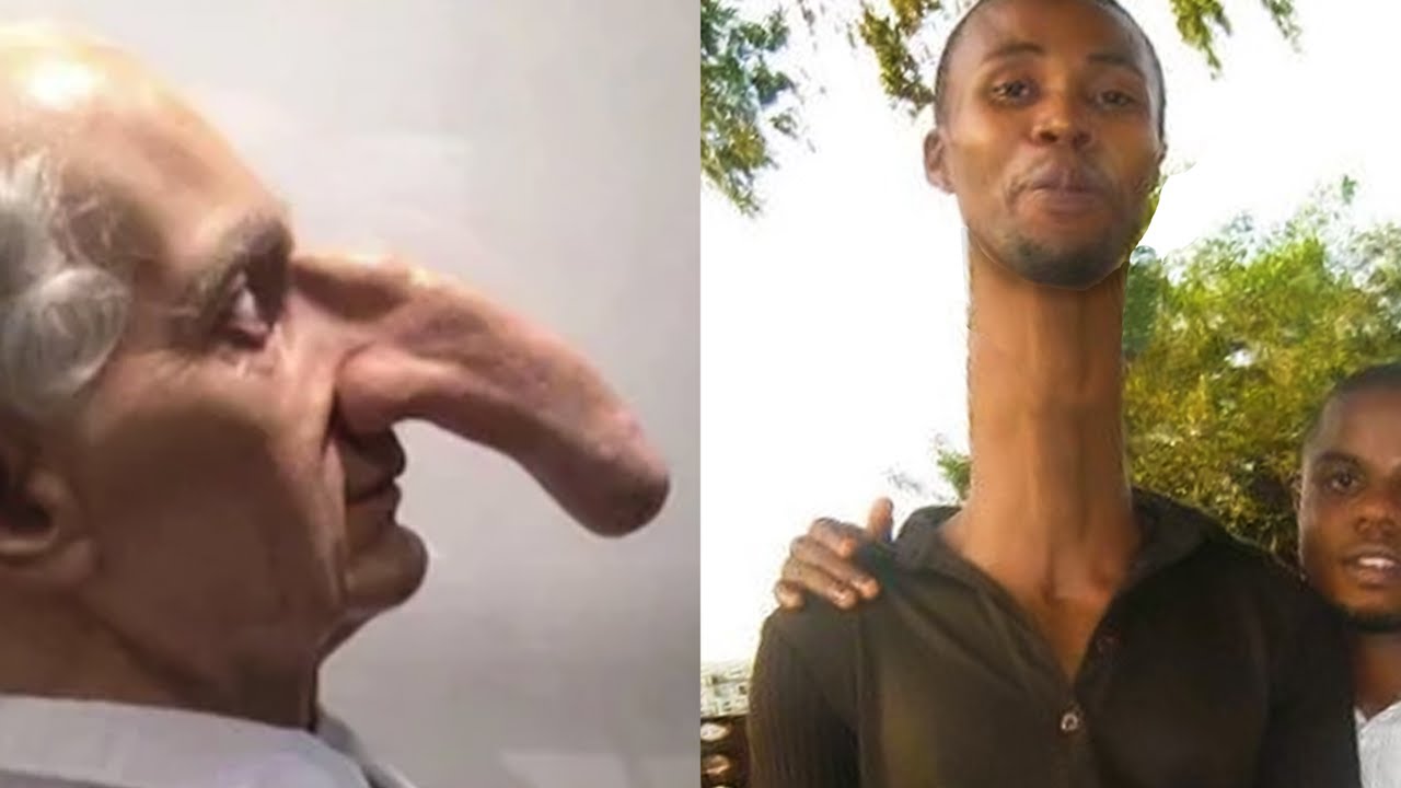 20 People With Bigger Than Normal Body Parts