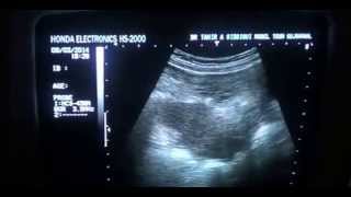 preview picture of video 'subserosal uterine  fundal region FIBROID'