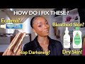How to fix Eczema , Skin Darkening and Dry Skin | Skin & Life Questions You Asked Me !