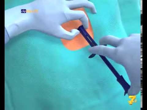Candele con propoli e grasso di capra da prostatite Cosa fare quando adenoma prostatico, che le operazioni di