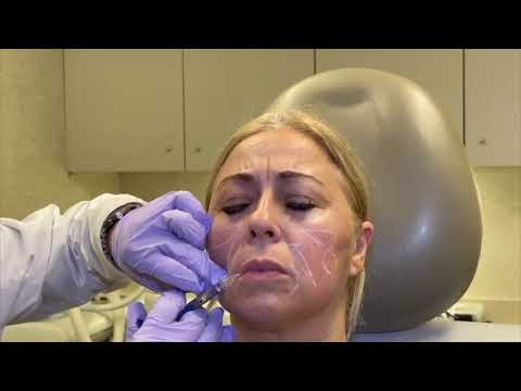 The RHA Collection of Fillers | Schweiger Dermatology Group