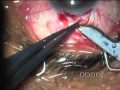 Trabeculectomy Rmvb
