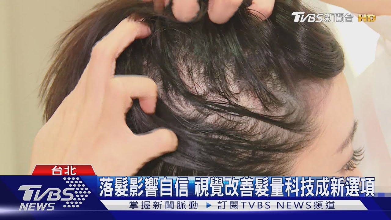 落髮影響自信　視覺改善髮量科技成新選項