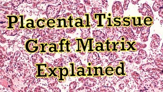 Placental Graft Matrix Treatment (PGM)/ Amniofix:  Explained by John E Stavrakos MD