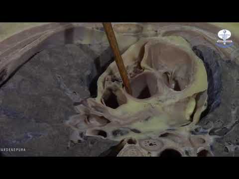 Cadaveric Demonstration Cross section at T4,T5 level by Dr Sajith Edirisinghe