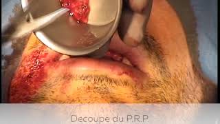 Pose d'implants avec greffe osseuse renforcée aux P.R.F