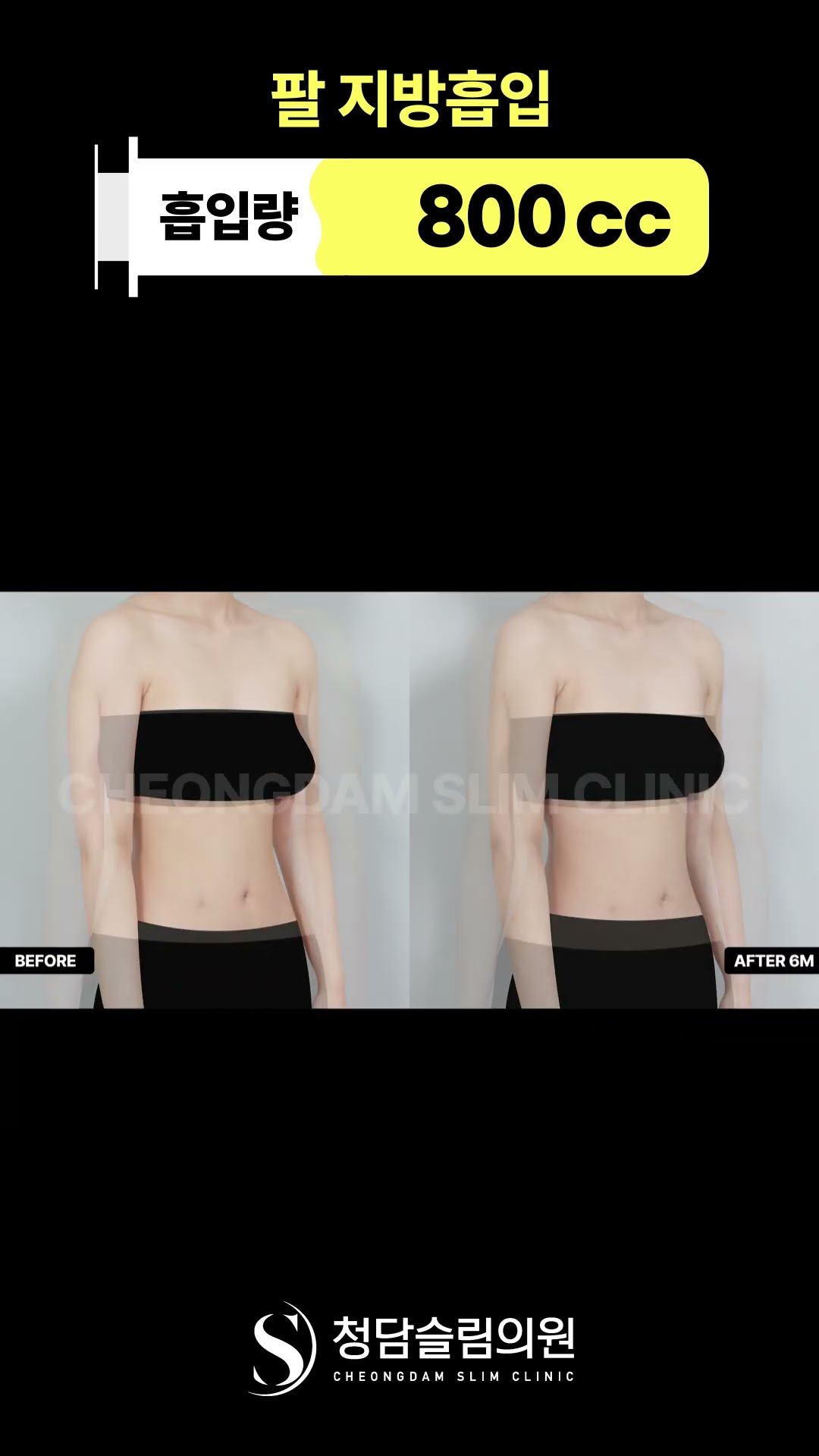 팔뚝 군살 정리 → 매끈한 라인 완성