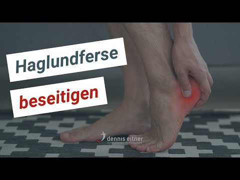 Haglund's deformity ➡️ Development and causal treatment (heel spur, Achilles tendon, heel pain)