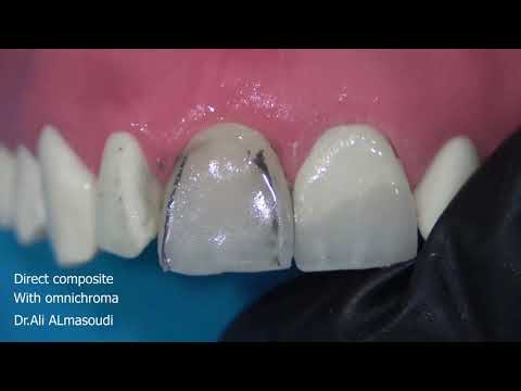 Direct Composite With Omnichroma