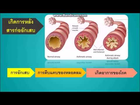 และชอบในการรักษาโรคสะเก็ดเงิน vulgaris รักษากลาก