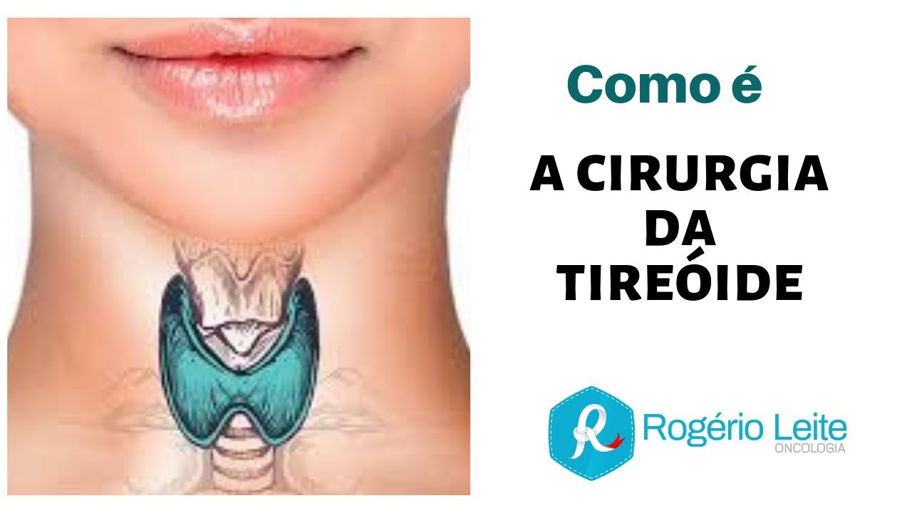 Tireoide: Como É A Cirurgia Da Tireoide