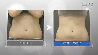 CLASSYS SCIZER Casos Clínicos EN 1