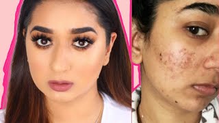 Hindi Video How To Cover Acne &amp; Scars | Easy Makeup Transformation Routine  (IF You Want To)