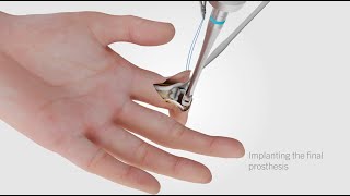 CapFlex PIP – Endoprothetische Versorgung des proximalen Interphalangealgelenks (palmarer Zugang)