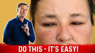 How to Fix the Swollen Face (Facial Puffiness) and Puffy Eyes – Dr.Berg