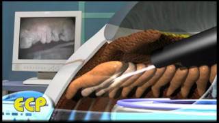 What is ECP and why is it helpful in treating glaucoma during a cataract procedure