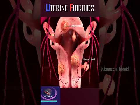 Uterine fibroids 3D animation #shorts