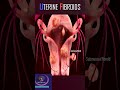 Uterine Fibroids 3D Animation Shorts