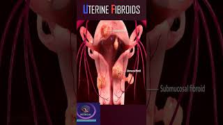 Download lagu Uterine fibroids 3D animation #shorts mp3