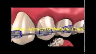 preview picture of video 'Orthodontic Tips-VaRam Dental VIrudhunagar'