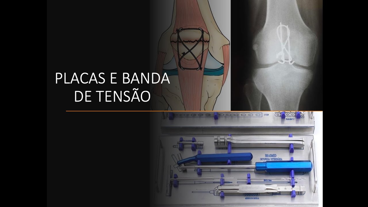 Princípios do tratamento das fraturas: placas e banda de tensão