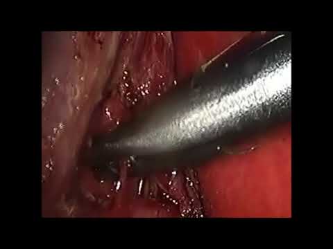 Laparoscopic Cholecystectomy for gallstones Video