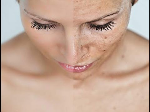 Argilla azzurra i pacchi di faccia di decolorazione Strade di trattamento di pigmentazione su una faccia
