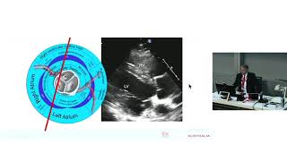 Echocardiographic Imaging in TAVI – Prof Greg Scalia