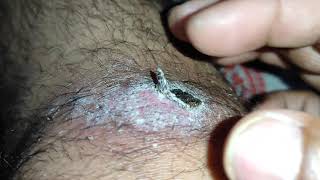 Skin Abrasion#The Scab on my Leg hasn’t fallen off yet after 17 Days.#A Second-Grade Abrasion Injury