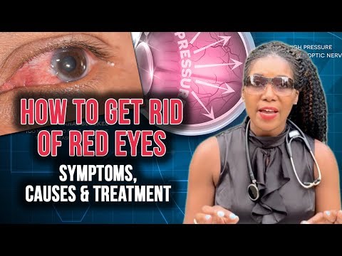 How To Get Rid Of Red Eyes: Top 5 Causes [2020]