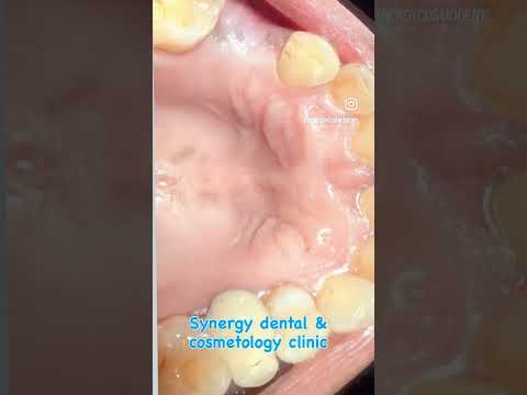 Implant supported prosthesis| Dr. Sushant Dambal