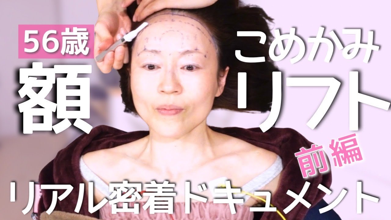 56歳、額こめかみリフト密着ドキュメント【前編】手術当日のリアル、全てお見せします