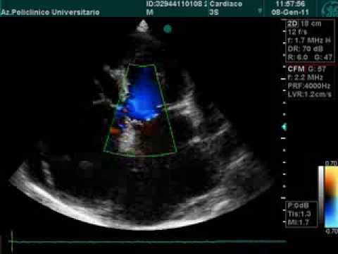 Atrial Dilatation, Pericardial Effusion In Echocardiography Examination