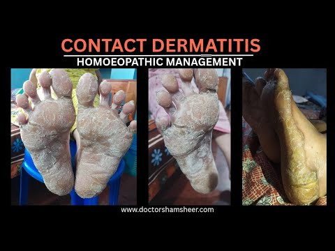 CONTACT DERMATITIS HOMOEOPATHIC MANAGEMENT