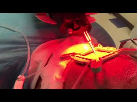 ARTAS Robotic Hair Transplant System Used During Procedure
