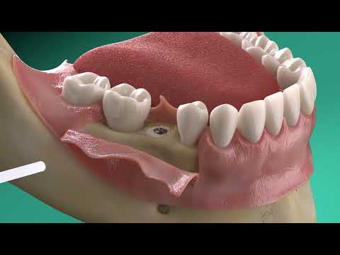 Straumann®️ GalvoSurge®️: Implant surface decontamination in peri-implantitis treatment