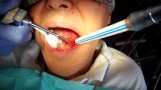 Implant Infection Removal #8