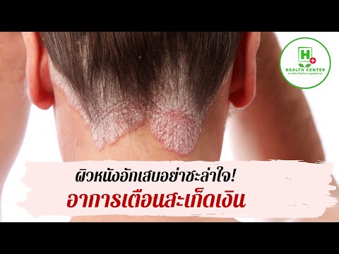 หนังศีรษะอักเสบโรคสะเก็ดเงิน โรคสะเก็ดเงินรีสอร์ท Berdiansk