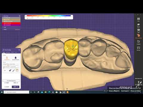 Exocad : Design perfect crown in 5 minutes